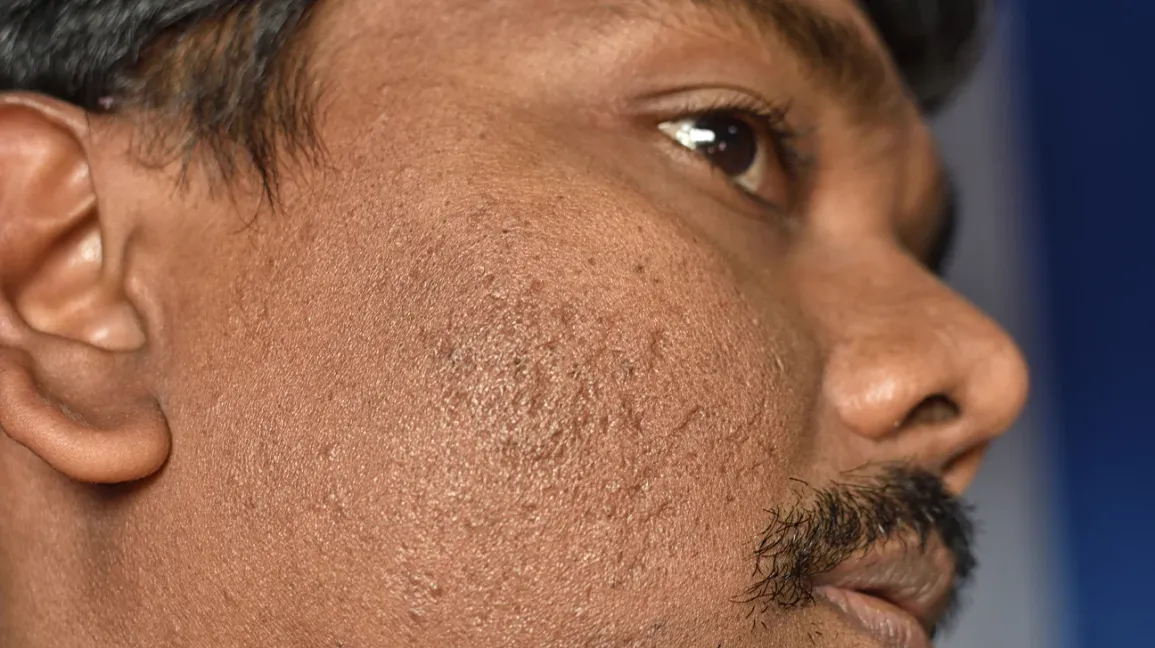 Atrophic Acne Scarring