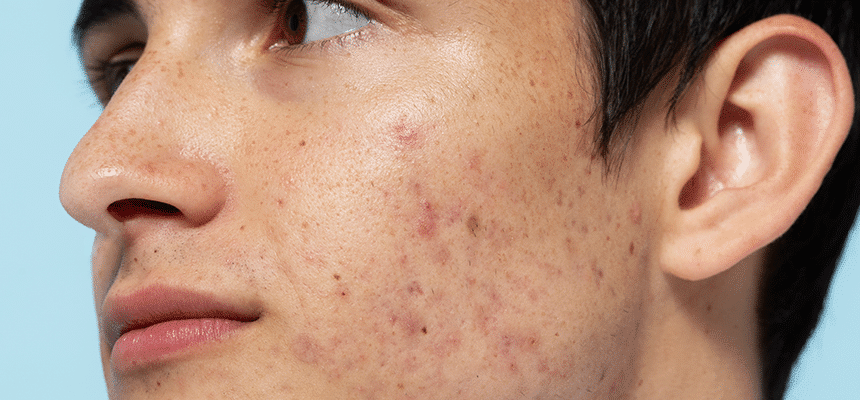 Acne