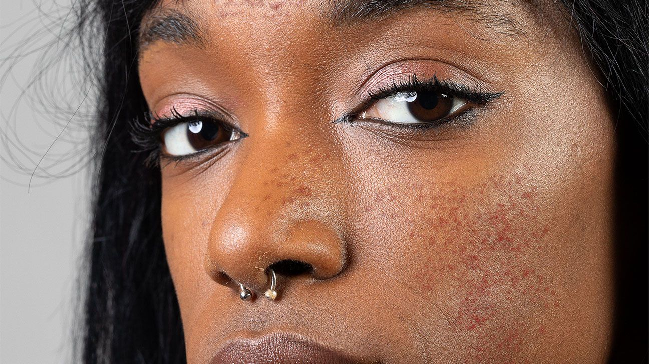 Rosacea