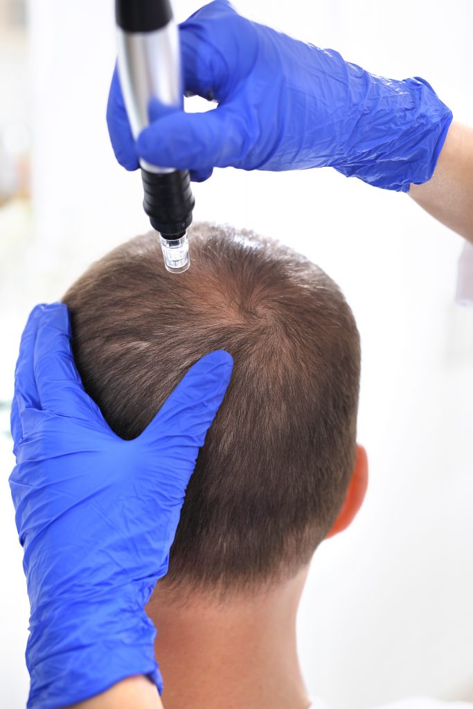 Exosomes Microneedling