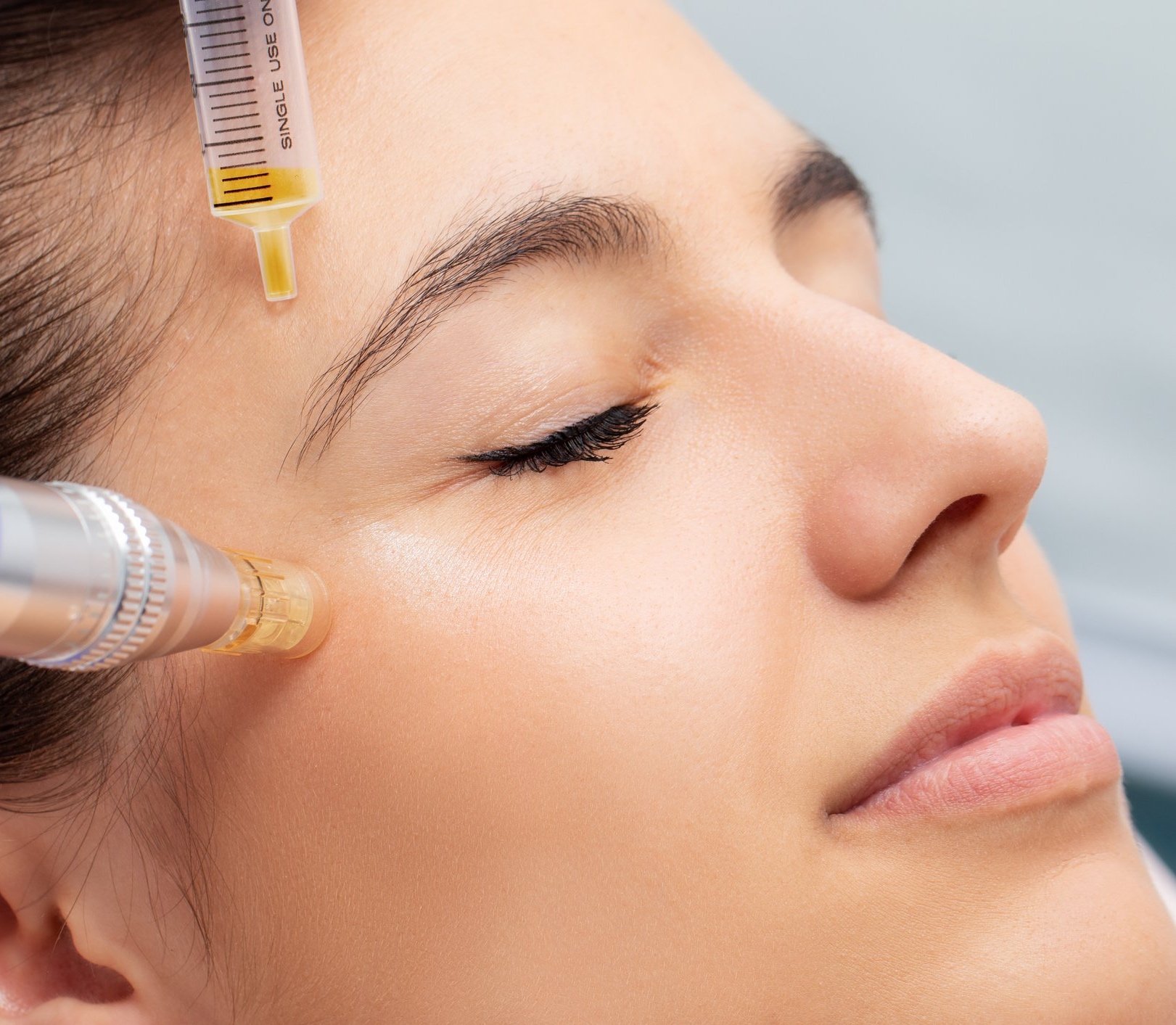 PRP Microneedling - 3x Treatment Course