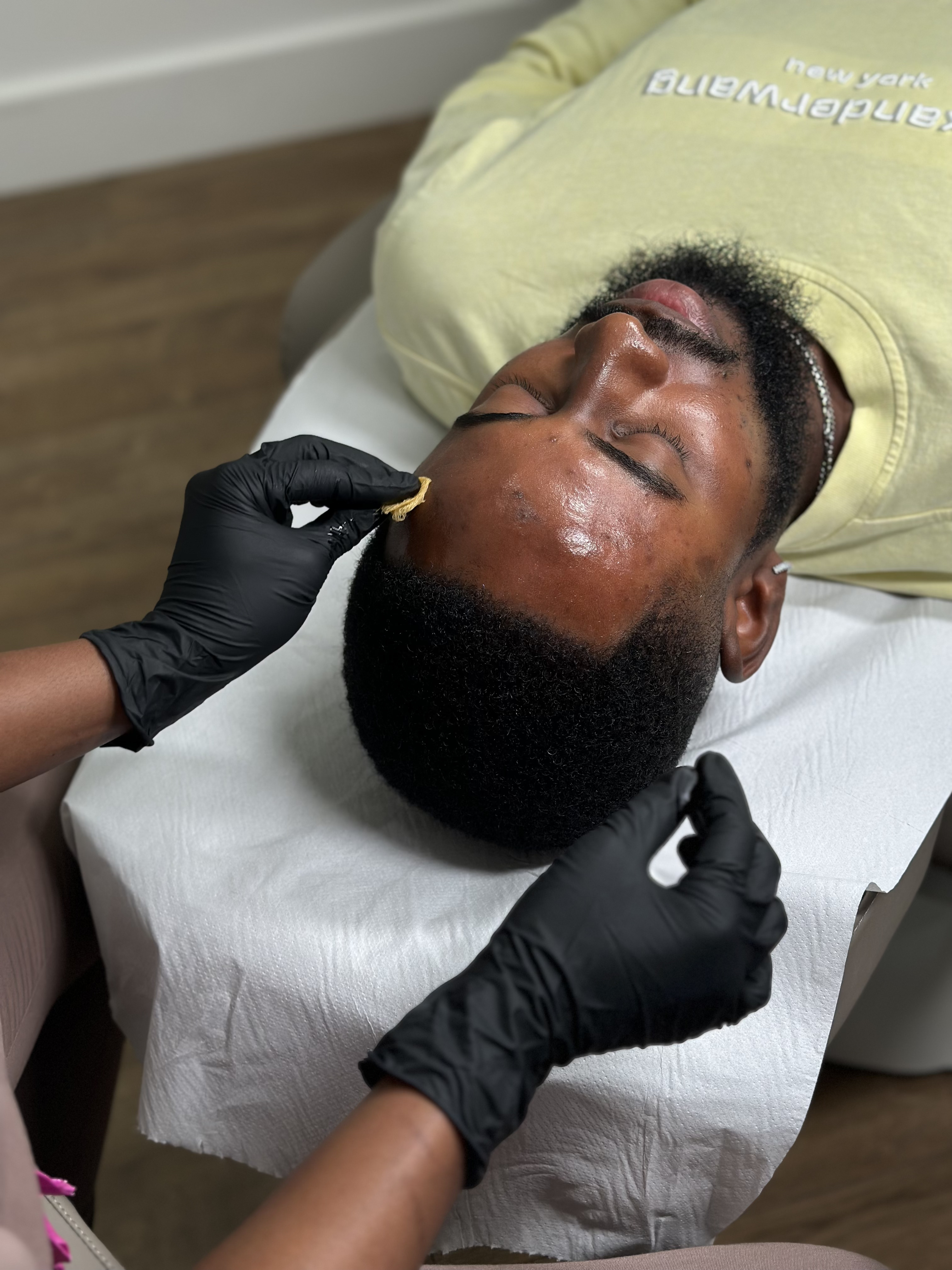 Chemical Peels